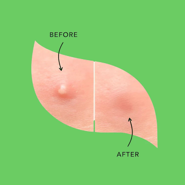 Fundamentals Get the Zit out Hydrocolloid Pimple Patches